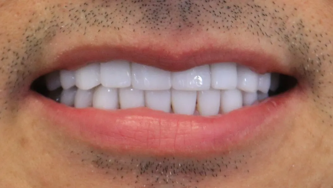 smile 10 aftr