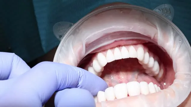 a close-up image showing a person's mouth during a veneers procedure