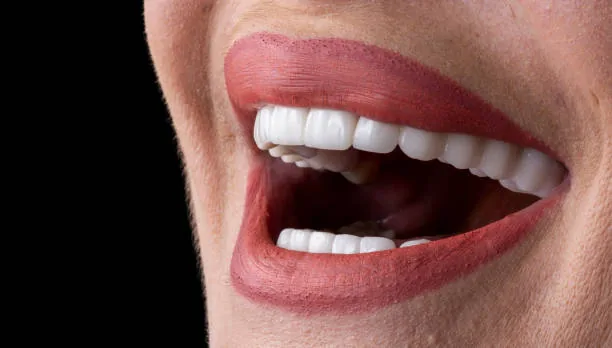 photo of a person's mouth with a complete set of veneers