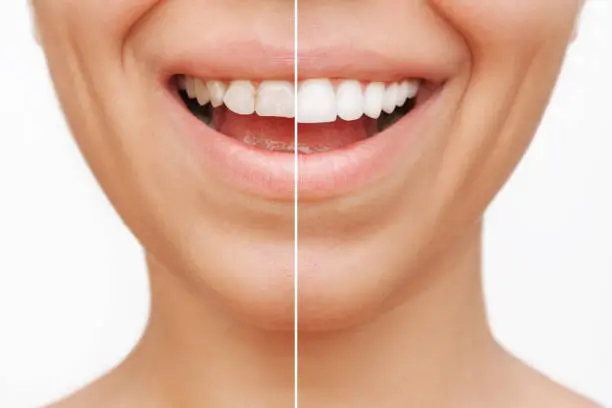 veneer2