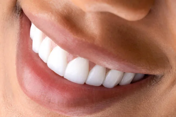 close-up shot of a set of teeth with veneers
