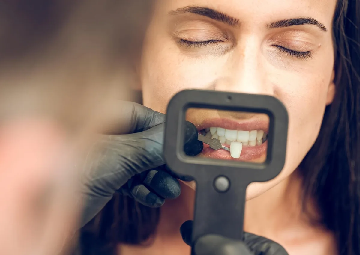 Dentist comparing tooth shades with a patient to select a natural-looking color for composite veneers.
